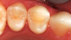 teeth that require restoration teeth that require restoration