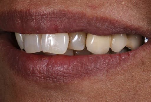 Close-up of patient smile