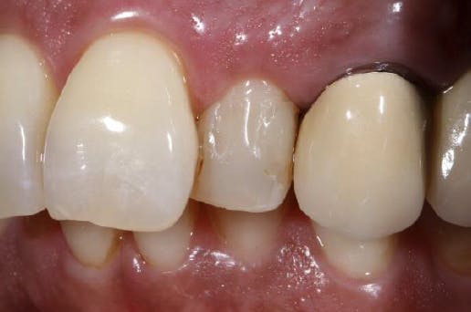 Close-up of patient's smile