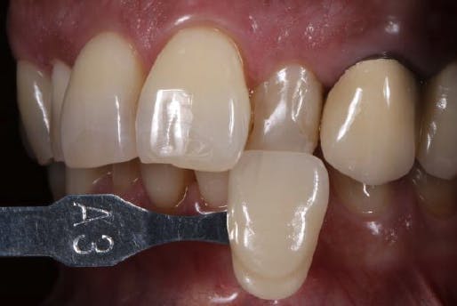 A3 veneer shade held up to patient's tooth