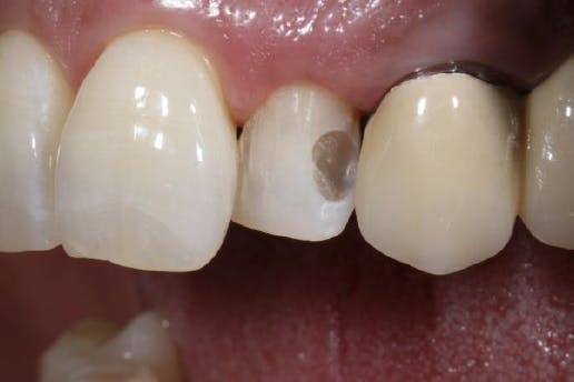 Old distal composite filling removal