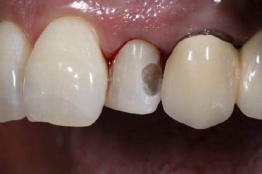 Teeth and bleeding gums