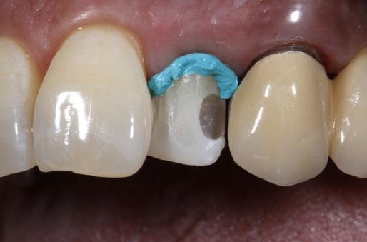 Teeth with blue paste on gums