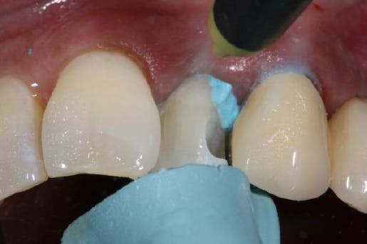 Dentist removing paste with water spray