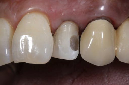 Patient's teeth and blood-free gums
