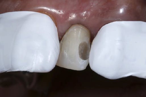 One tooth exposed, Teflon tape covering adjacent teeth