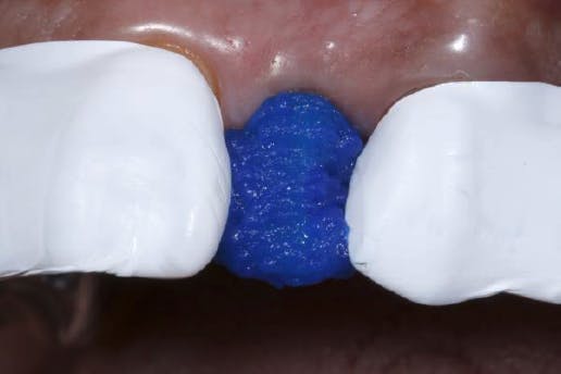 Blue gel covering exposed tooth