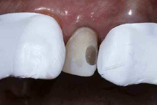 One exposed tooth with tape covering adjacent teeth