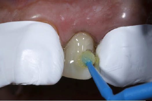 Microbrush applying bonding agent to one exposed tooth