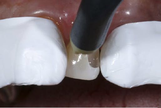 Compressed air wand drying one exposed tooth