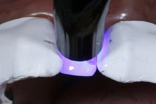 UV light shining on one exposed tooth