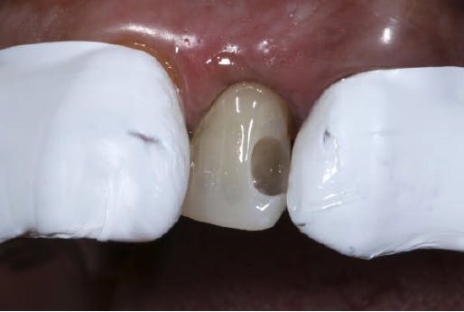 One shiny tooth exposed, adjacent teeth covered with tape