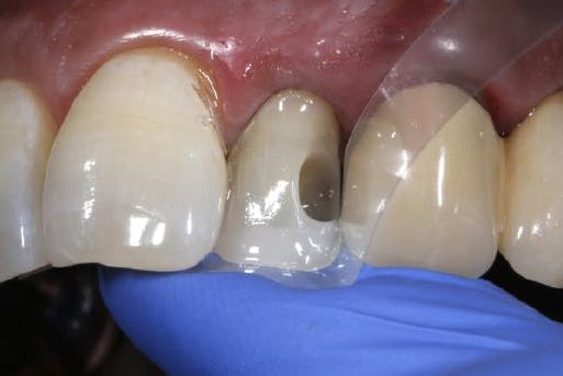 Clear matrix between damaged tooth and adjacent tooth