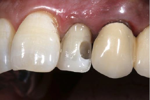 Close-up of patient's teeth after GrandioSO 4U