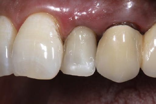 Patient's teeth after filling