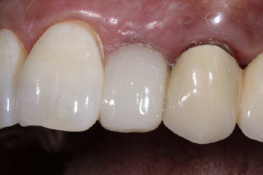 Patient's teeth