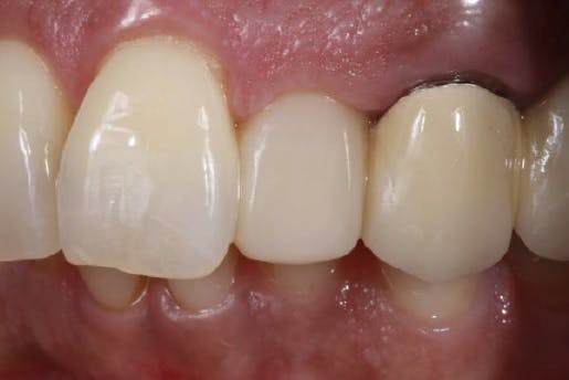 Final view of patient's teeth after restoration