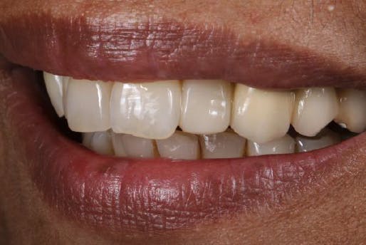 Final photo of patient's smile after restoration