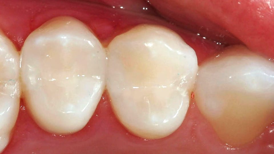 clinical photo showing dental composite restorations