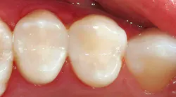 clinical photo showing dental composite restorations