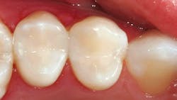 clinical photo showing dental composite restorations clinical photo showing dental composite restorations