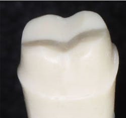 tooth preparation tooth preparation