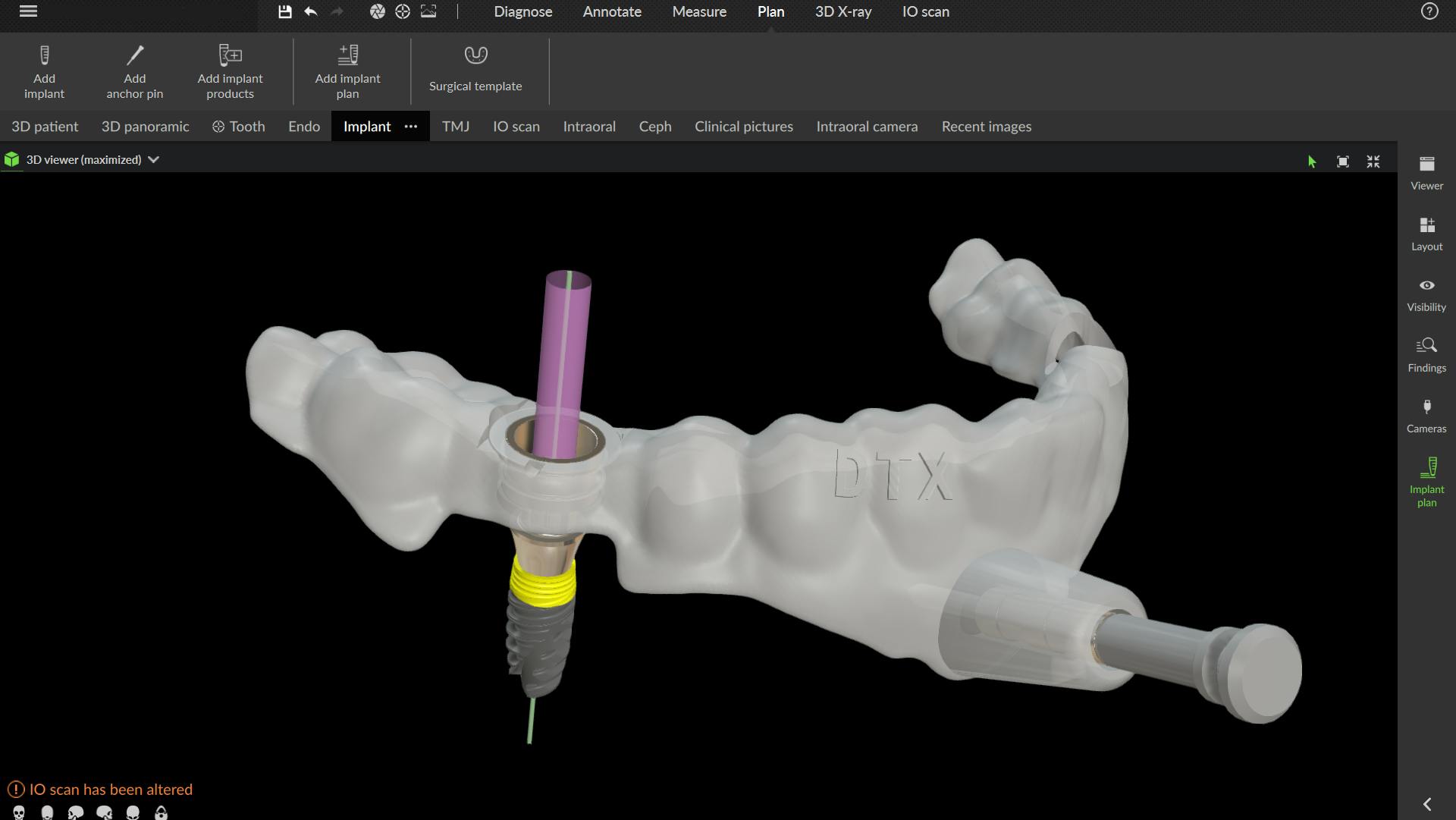 dental surgical guide design