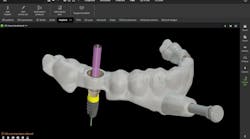 dental surgical guide design dental surgical guide design