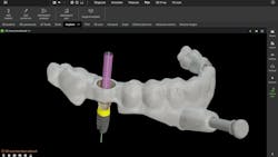 dental surgical guide design dental surgical guide design