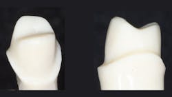 dental crown preps dental crown preps