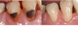 teeth with cavities and teeth with restorations teeth with cavities and teeth with restorations