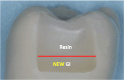 picture of a tooth with composite picture of a tooth with composite