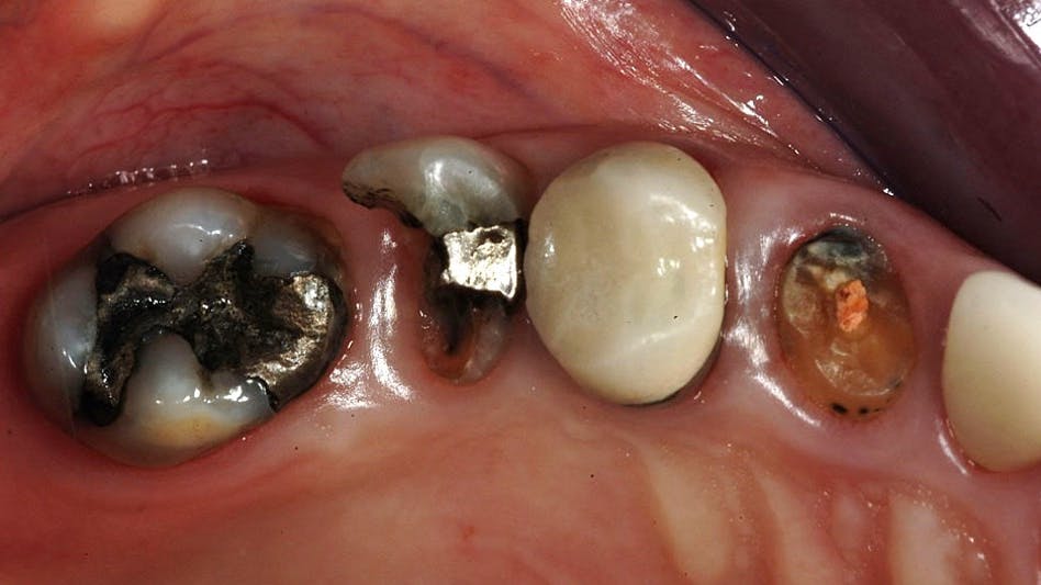 broken-down teeth requiring restoration