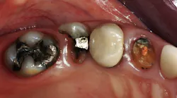 broken-down teeth requiring restoration broken-down teeth requiring restoration