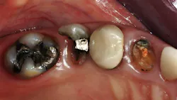 broken-down teeth requiring restoration broken-down teeth requiring restoration