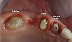 restored teeth restored teeth