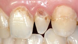 dental tooth decay dental tooth decay