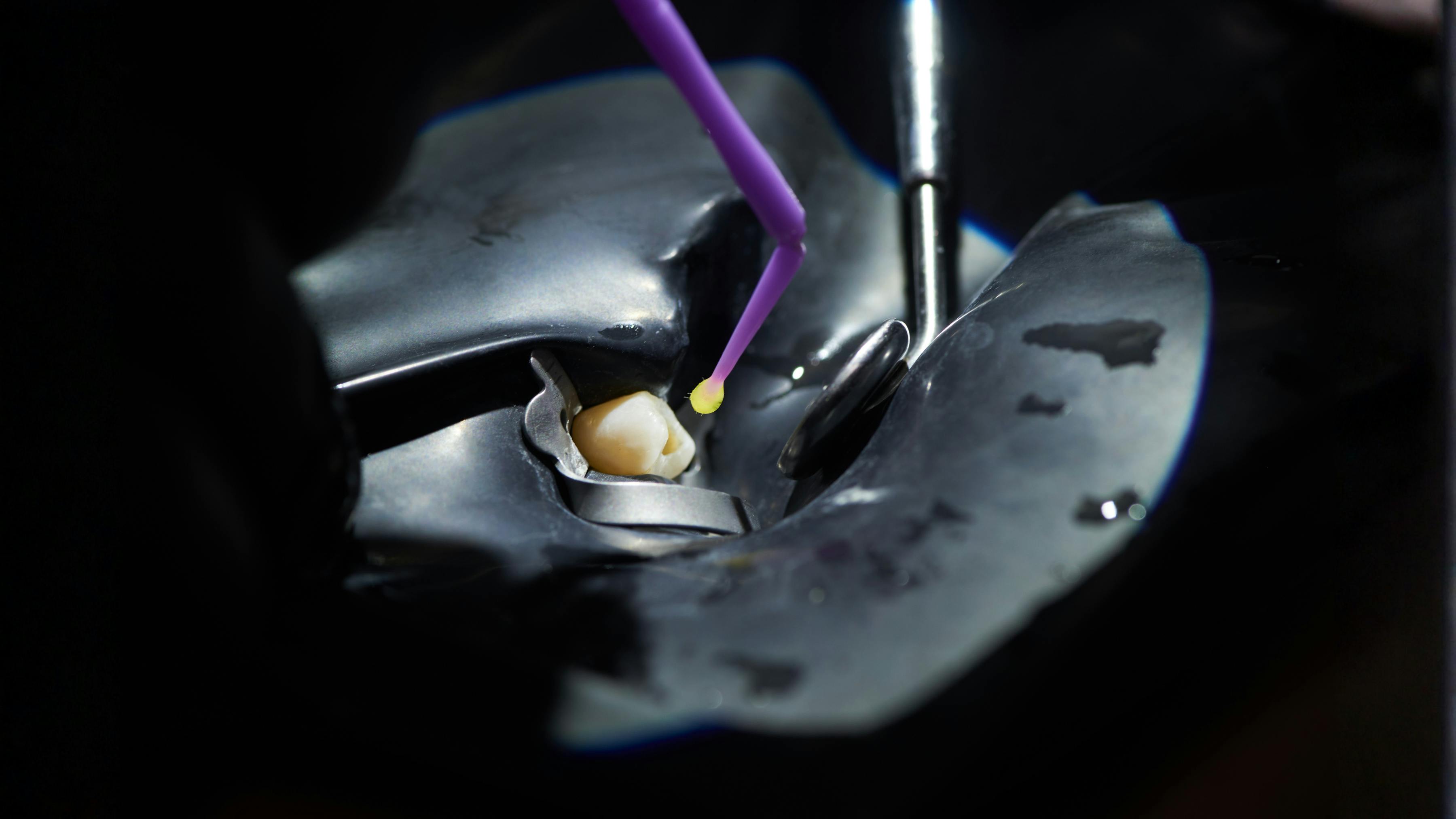 Image of a tooth and dentin bonding procedure