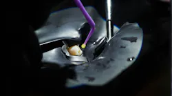 Image of a tooth and dentin bonding procedure Image of a tooth and dentin bonding procedure