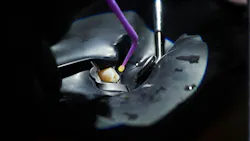 Image of a tooth and dentin bonding procedure Image of a tooth and dentin bonding procedure