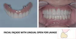 fixed dental prosthesis fixed dental prosthesis