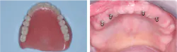 denture supported by implants denture supported by implants