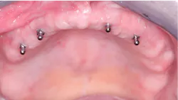 maxillary denture retained and supported by implants maxillary denture retained and supported by implants