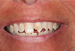 crown fractures of teeth