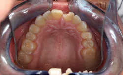palatal view of teeth in need of repair