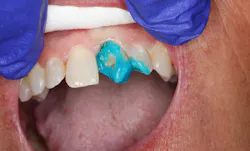 selective enamel etching of the teeth