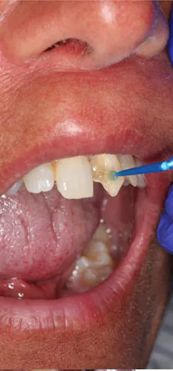 applying bonding agent to teeth