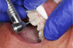 placing composite on teeth