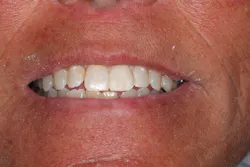 completed composite tooth restorations