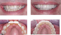 dental restorations